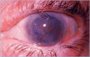 trachoma